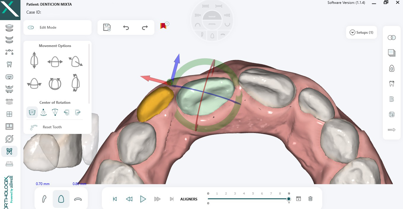 Orthologix: sistema de fuerzas 3D con vectores sobre un diente