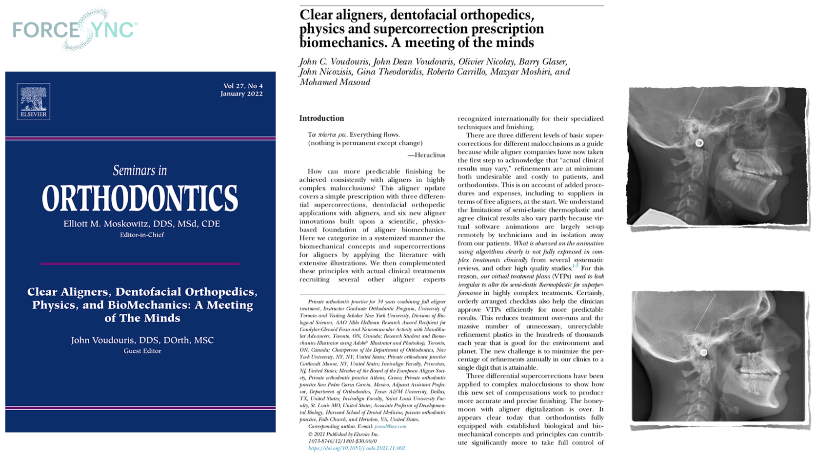 Artículo en Seminars in Orthodontics, Elsevier, sobre biomecánica de alineadores